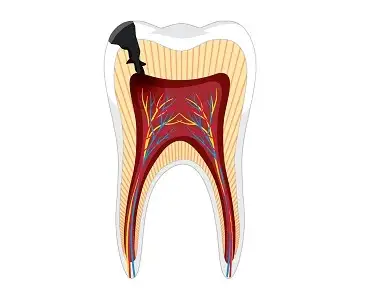 Coafaj dentar