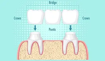 Dental bridges