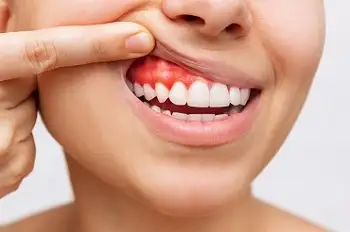 Gingivoplastie