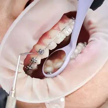Damon braces