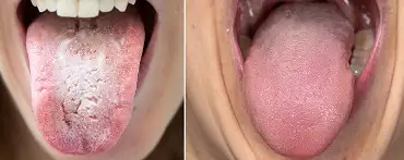 Hygiene of the tongue - example
