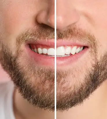 Gingivoplastie - inainte si dupa